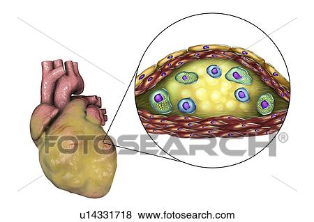 Stock Photo - Heart disease, computer illustration. Diseased fatty heart and cross-section of an atherosclerotic plaque and its histological structure, such as necrotic centre, foam cells and T-lymphocytes. Its walls are made of smooth muscle cells and endothelium.... Fotosearch