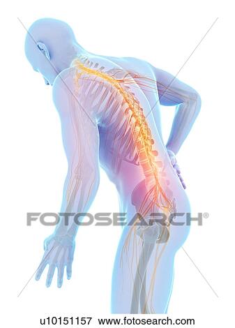 Stock Photo - Human back nerve pain, computer artwork.. Fotosearch