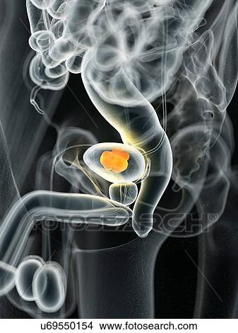 Human bladder cancer, computer illustration. View Large Photo Image Picture - Human bladder cancer, computer illustration.. Fotosearch