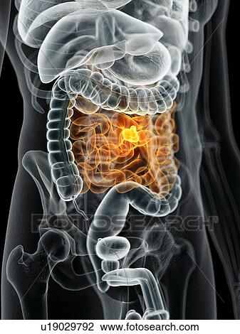 Human bowel cancer, computer illustration. View Large Photo Image Stock Image - Human bowel cancer, computer illustration.. Fotosearch