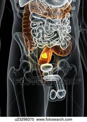 Stock Photography - Human bowel cancer, computer illustration.. Fotosearch