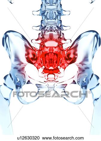 Stock Image - Human hip pain, computer artwork.. Fotosearch