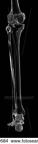 Human leg bones, computer illustration. View Large Photo Image Picture - Human leg bones, computer illustration.. Fotosearch