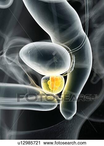 Stock Image - Human prostate cancer, computer illustration.. Fotosearch