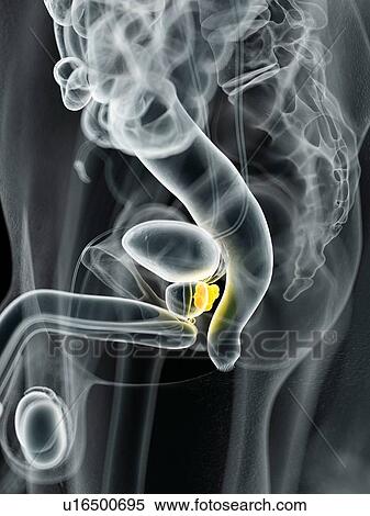 Stock Photography - Human prostate cancer, computer illustration.. Fotosearch