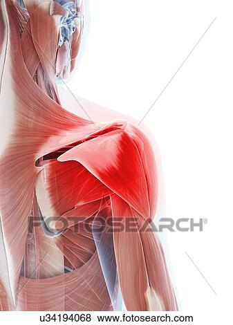 Stock Photo - Human shoulder muscle pain, computer artwork.. Fotosearch