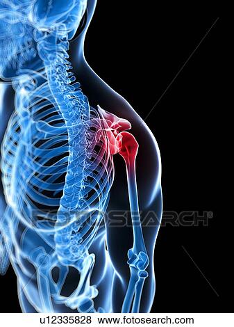 Stock Photo - Human shoulder pain, computer artwork.. Fotosearch
