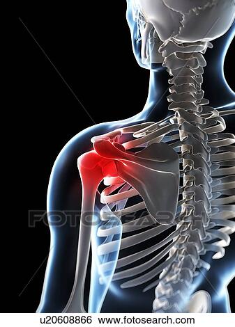 Stock Photograph - Human shoulder pain, computer artwork.. Fotosearch