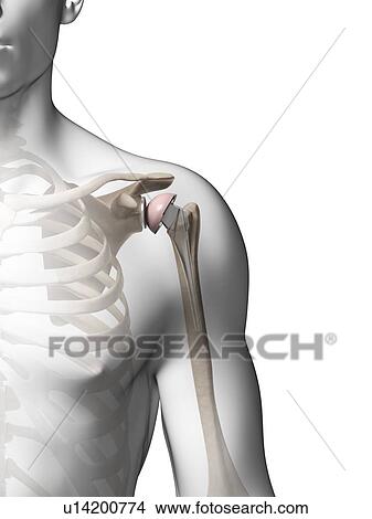 Human shoulder replacement, computer artwork. View Large Photo Image Picture - Human shoulder replacement, computer artwork.. Fotosearch