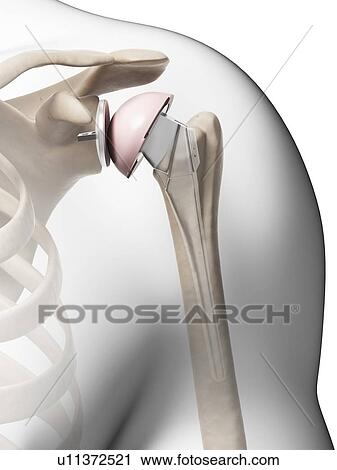 Stock Image - Human shoulder replacement, computer artwork.. Fotosearch