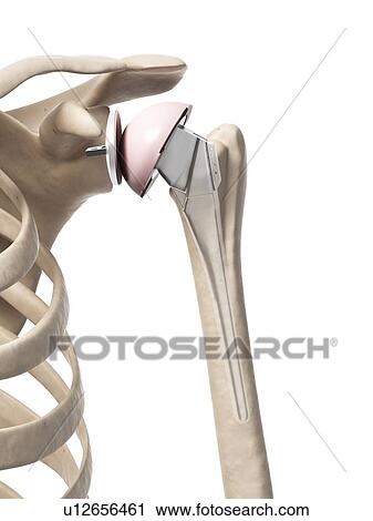 Stock Image - Human shoulder replacement, computer artwork.. Fotosearch
