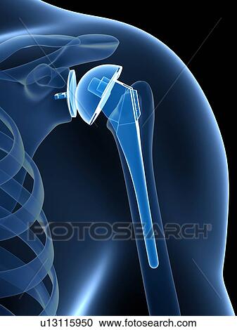 Stock Image - Human shoulder replacement, computer artwork.. Fotosearch
