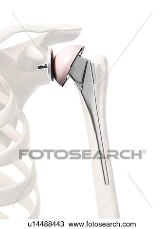 Stock Image - Human shoulder replacement, computer artwork.. Fotosearch