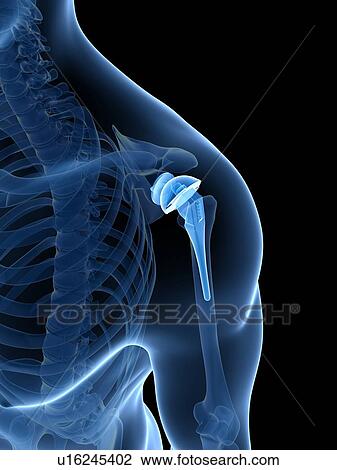 Stock Image - Human shoulder replacement, computer artwork.. Fotosearch
