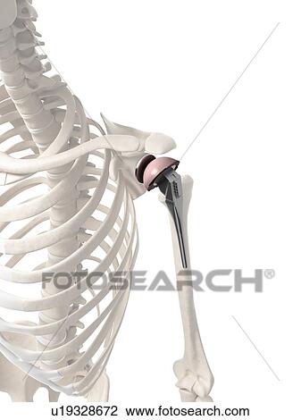 Stock Image - Human shoulder replacement, computer artwork.. Fotosearch