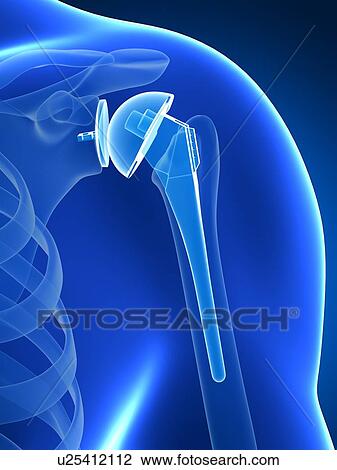 Stock Image - Human shoulder replacement, computer artwork.. Fotosearch