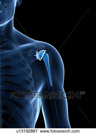 Stock Photo - Human shoulder replacement, computer artwork.. Fotosearch