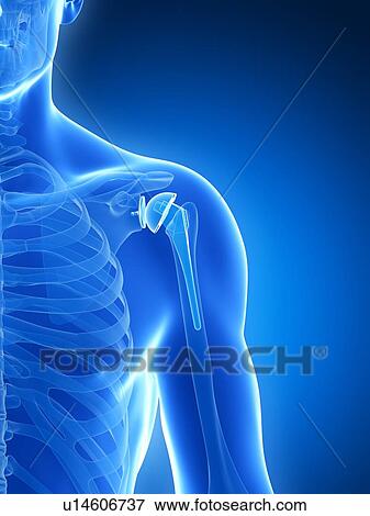 Stock Photo - Human shoulder replacement, computer artwork.. Fotosearch