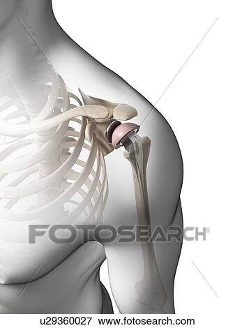 Stock Photo - Human shoulder replacement, computer artwork.. Fotosearch