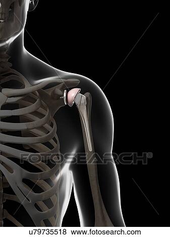 Stock Photo - Human shoulder replacement, computer artwork.. Fotosearch