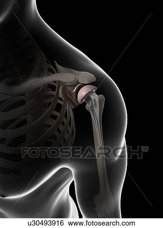Stock Photograph - Human shoulder replacement, computer artwork.. Fotosearch