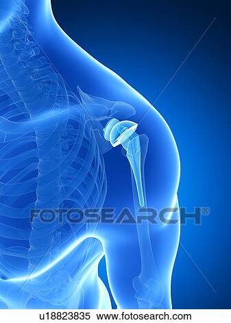 Stock Photography - Human shoulder replacement, computer artwork.. Fotosearch