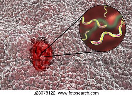Stock Image - Illustration of a gastric (stomach) ulcer with a close-up view of Helicobacter pylori bacteria. Gastric, or peptic, ulcers are erosions of the mucosal lining of the stomach. Helicobacter pylori is a curved, or spiral, Gram-negative bacilli with.... Fotosearch