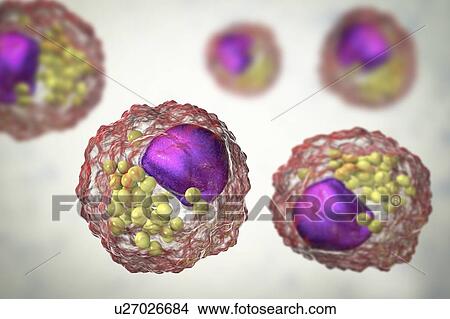 Macrophage foam cell, illustration. Foam cells are macrophage cells that contain lipid droplets and are components of atherosclerotic plaque. View Large Photo Image Picture - Macrophage foam cell, illustration. Foam cells are macrophage cells that contain lipid droplets and are components of atherosclerotic plaque.. Fotosearch