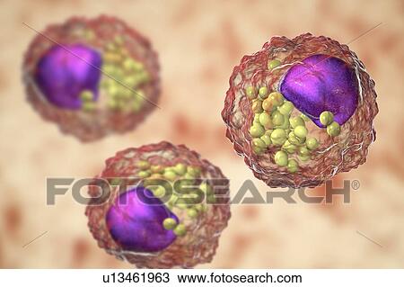 Macrophage foam cell, illustration. Foam cells are macrophage cells that contain lipid droplets and are components of atherosclerotic plaque. View Large Photo Image Stock Image - Macrophage foam cell, illustration. Foam cells are macrophage cells that contain lipid droplets and are components of atherosclerotic plaque.. Fotosearch