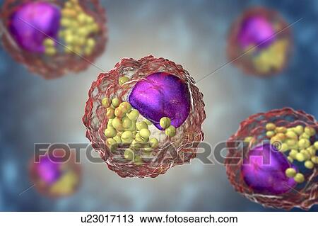 Stock Image - Macrophage foam cell, illustration. Foam cells are macrophage cells that contain lipid droplets and are components of atherosclerotic plaque.. Fotosearch