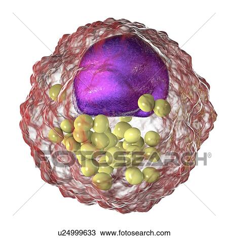 Stock Image - Macrophage foam cell, illustration. Foam cells are macrophage cells that contain lipid droplets and are components of atherosclerotic plaque.. Fotosearch