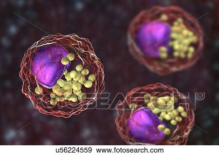 Stock Photo - Macrophage foam cell, illustration. Foam cells are macrophage cells that contain lipid droplets and are components of atherosclerotic plaque.. Fotosearch