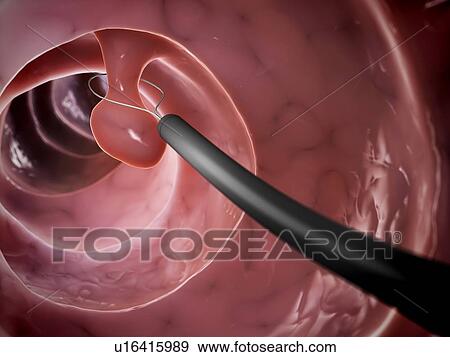 Stock Photo - Removal of polyp, computer artwork.. Fotosearch