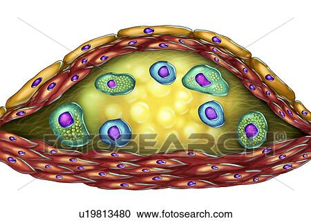 Stock Image - Structure of atherosclerotic plaque, computer illustration. The necrotic centre, foam cells and T-lymphocytes are seen inside of the cholesterol plaque. The walls are made of smooth muscle cells and endothelium from the blood vessel.. Fotosearch