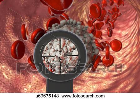 Stock Photo - Treatment of leukaemia. Conceptual illustration showing optical sight direct on leukaemia cancer cell.. Fotosearch