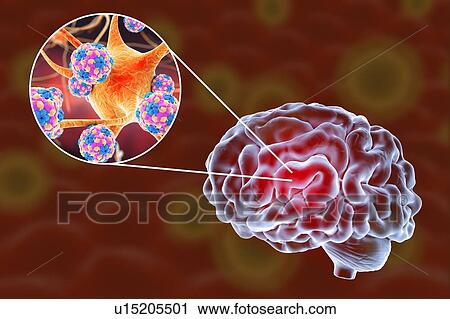 Stock Image - Viral encephalitis. Conceptual illustration showing brain and close-up view of viruses infecting neurons.. Fotosearch
