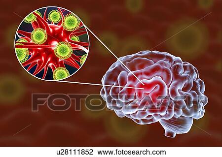 Stock Image - Viral encephalitis. Conceptual illustration showing brain and close-up view of viruses infecting neurons.. Fotosearch
