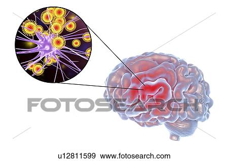 Stock Photo - Viral encephalitis. Conceptual illustration showing brain and close-up view of viruses infecting neurons.. Fotosearch