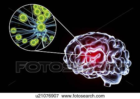 Viral encephalitis. Conceptual illustration showing brain and close-up view of viruses infecting neurons. View Large Photo Image Stock Photo - Viral encephalitis. Conceptual illustration showing brain and close-up view of viruses infecting neurons.. Fotosearch