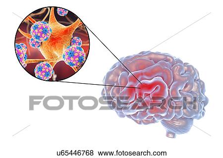 Stock Photo - Viral encephalitis. Conceptual illustration showing brain and close-up view of viruses infecting neurons.. Fotosearch