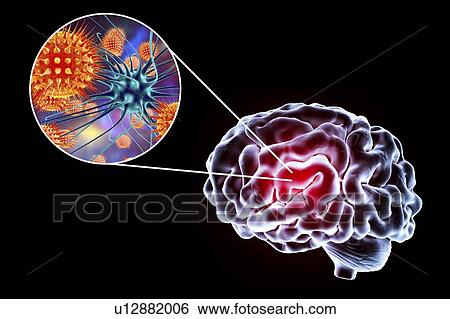 Stock Photograph - Viral encephalitis. Conceptual illustration showing brain and close-up view of viruses infecting neurons.. Fotosearch