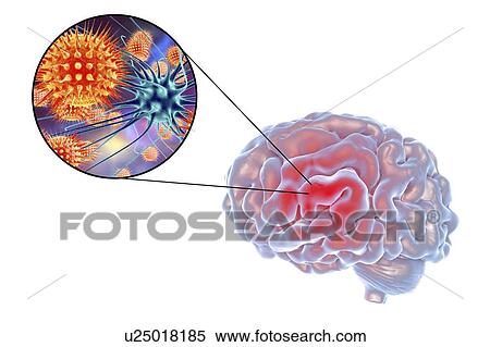 Stock Photography - Viral encephalitis. Conceptual illustration showing brain and close-up view of viruses infecting neurons.. Fotosearch