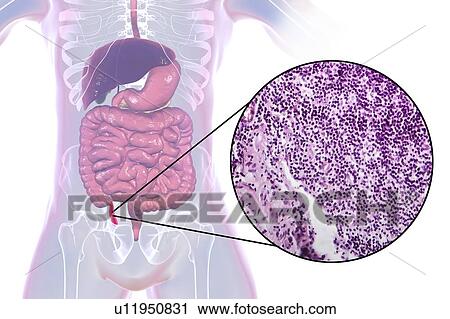 Stock Image - Acute appendicitis, computer illustration and light micrograph. Illustration of a human appendix that is red and inflamed in appendicitis. The appendix is a narrow finger-shaped tube that branches off the first part of the large intestine (caecum,.... Fotosearch