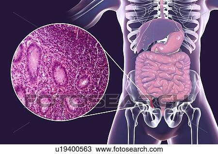 Acute appendicitis, computer illustration and light micrograph. Illustration of a human appendix that is red and inflamed in appendicitis. The appendix is a narrow finger-shaped tube that branches off the first part of the large intestine (caecum,... View Large Photo Image Stock Image - Acute appendicitis, computer illustration and light micrograph. Illustration of a human appendix that is red and inflamed in appendicitis. The appendix is a narrow finger-shaped tube that branches off the first part of the large intestine (caecum,.... Fotosearch