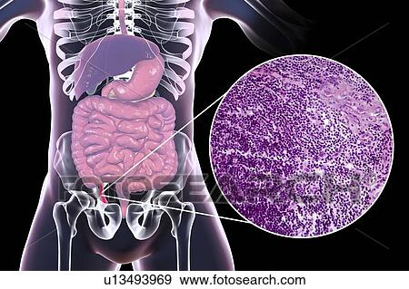 Acute appendicitis, computer illustration and light micrograph. Illustration of a human appendix that is red and inflamed in appendicitis. The appendix is a narrow finger-shaped tube that branches off the first part of the large intestine (caecum,... View Large Photo Image Stock Photo - Acute appendicitis, computer illustration and light micrograph. Illustration of a human appendix that is red and inflamed in appendicitis. The appendix is a narrow finger-shaped tube that branches off the first part of the large intestine (caecum,.... Fotosearch