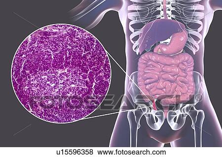 Stock Photo - Acute appendicitis, computer illustration and light micrograph. Illustration of a human appendix that is red and inflamed in appendicitis. The appendix is a narrow finger-shaped tube that branches off the first part of the large intestine (caecum,.... Fotosearch