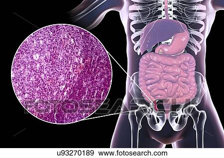 Acute appendicitis, computer illustration and light micrograph. Illustration of a human appendix that is red and inflamed in appendicitis. The appendix is a narrow finger-shaped tube that branches off the first part of the large intestine (caecum,... View Large Photo Image Stock Photo - Acute appendicitis, computer illustration and light micrograph. Illustration of a human appendix that is red and inflamed in appendicitis. The appendix is a narrow finger-shaped tube that branches off the first part of the large intestine (caecum,.... Fotosearch