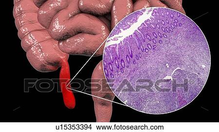 Acute suppurative appendicitis, computer illustration and light micrograph. Illustration of a human appendix that is red and inflamed in appendicitis. The appendix is a narrow finger-shaped tube that branches off the first part of the large intestine... View Large Photo Image Picture - Acute suppurative appendicitis, computer illustration and light micrograph. Illustration of a human appendix that is red and inflamed in appendicitis. The appendix is a narrow finger-shaped tube that branches off the first part of the large intestine.... Fotosearch