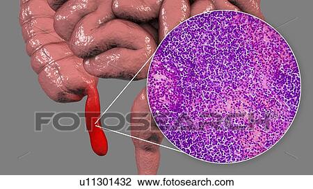 Stock Image - Acute suppurative appendicitis, computer illustration and light micrograph. Illustration of a human appendix that is red and inflamed in appendicitis. The appendix is a narrow finger-shaped tube that branches off the first part of the large intestine.... Fotosearch