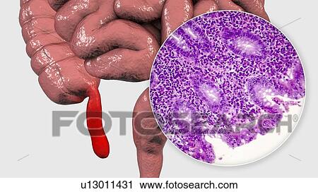 Stock Image - Acute suppurative appendicitis, computer illustration and light micrograph. Illustration of a human appendix that is red and inflamed in appendicitis. The appendix is a narrow finger-shaped tube that branches off the first part of the large intestine.... Fotosearch